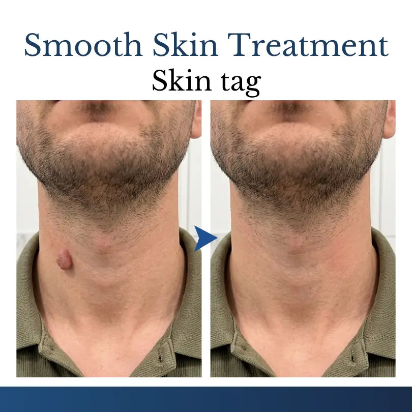 DermaVelle™ | 2-in-1 Mikronadel-Pflaster | Für sichtbar glattere Haut & weniger Hautanhängsel